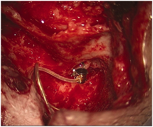 Figure 4. Intraoperative picture of the VSB coupled to the short process of the incus.