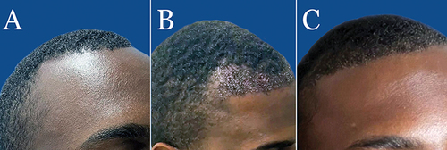 Figure 5 A 28-year-old curly-haired African-American man before long-hair FUE using a skin-responsive FUE device (A). Immediately after the implantation of 1820 long-shafted grafts to the hairline; a preview of the results was not possible, as the grafted hair shafts were matted onto the scalp (B). Five days later, the long-hair shafted grafts were unstuck, enabling a preview of the results (C).