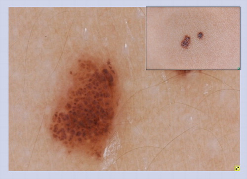 Figure 5. Cobblestone congenital melanocytic nevus.Globules of differing sizes with angulation and crowding of the globules create a characteristic cobblestone pattern.
