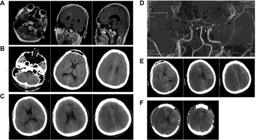 Figure 1 Preoperative and postoperative findings by MRI and CT.