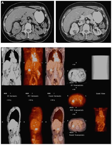 Figure 3 A 71-year-old female who presented with an incidentally diagnosed, enhancing 4 cm right renal mass (A), which demonstrated positive uptake on 124I-girentuximab (G250) positron emission tomography/computed tomography (B); pathology following open partial nephrectomy revealed pathologic stage T1b Nx Mx clear cell renal cell carcinoma.
