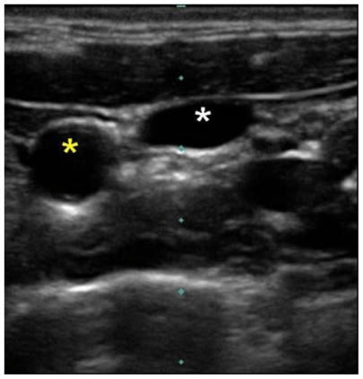 Figure 8 Ultrasound image of right internal jugular vein compressed by gentle probe pressure (white star) and carotid artery (yellow star).