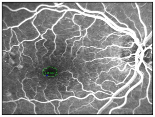 Figure 1 The foveal avascular zone was manually circumscribed on an early-phase fluorescein angiogram and the software measured the area (in mm2).