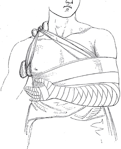 Figure 12. Liston’s bandage. Reprinted from Liston (Citation1838) 101.