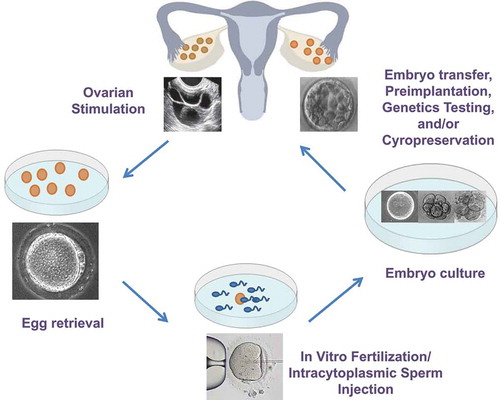 Figure 1. In vitro fertilization involved multiple exposures and manipulations to the gamete and embryo including superovulation, the surgical retrieval of oocytes, in vitro fertilization by sperm or injection of a single sperm into the oocyte (Intracytoplasmic sperm injection), the culture of fertilized embryos for 3–5 days, and the transfer of fresh embryos and/or embryo cryopreservation.