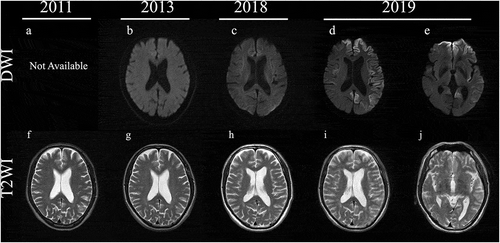 Figure 1. Magnetic resonance imaging (MRI) findings in diffusion-weighted images (DWI) and T2-weighted images (T2WI) in the brain from 2011 to 2019. MRI examinations were normal in DWI and T2WI from 2011 to 2018 (a–c, g–h). In 2019, right dominant cortical high-intensity signals, except in the occipital lobe, in DWI (d) and abnormal swelling in T2WI (i) were detected. The corpus callosum and caudate were normal in DWI and T2WI (c,j).