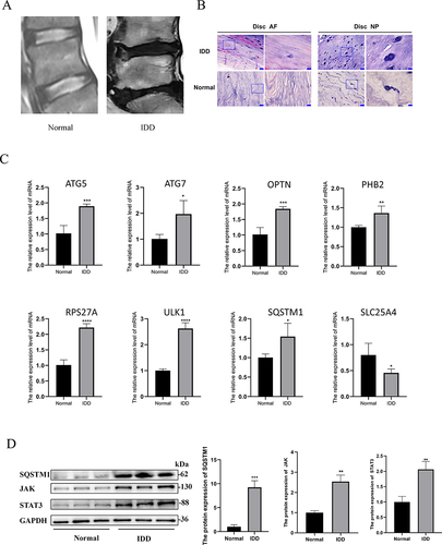 Figure 7 The relative expression of hub genes mRNA and downstream protein. (A) MRI of clinical sample. (B) HE staining representation of AF and NP in IDD and normal discs (scale bars = 100μm in low magnified pictures and scale bars = 25μm in high magnified pictures). (C) Hub genes (ATG5, ATG7, OPTN, PHB2, RPS27A, ULK1, SQSTM1, SLC25A4) expression levels in IDD groups. (D) Western blot analysis of SQSTM1 and JAK/STAT3 pathway of different groups. *p < 0.05, **p < 0.01 and ***p < 0.001.