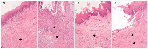 Figure 10. Pictures of H&E-stained gingival tissues, (A) healthy rabbits without any operation, (B) rabbits with periodontitis after 1 day of operation without treatment, (C) periodontitis rabbits receiving TNZ-loaded in situ gel forming system after 7 days of administration, (D) periodontitis rabbits receiving NMP solution of TNZ after 7 days of administration. → the collagen fibrils, and ▴ the inflammatory cell.