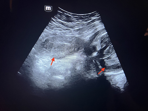 Figure 1 Transabdominal ultrasound showing two adjacent noncommunicating uteri (arrows), one of which is empty and the other is bearing a fetus.