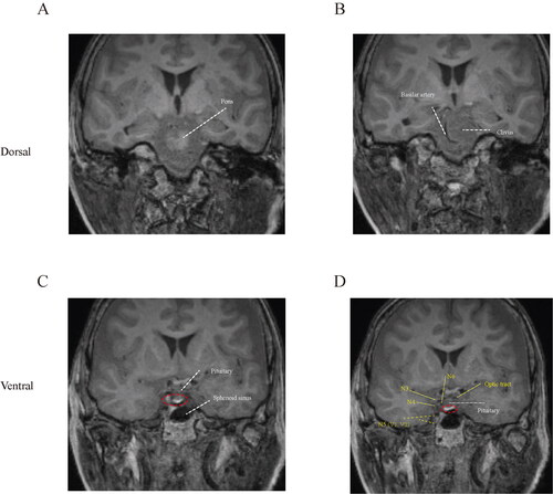 Figure 2. Coronal view of MR cisternography. (A–D) Dorsal to ventral sections of prepontine cisternal scanning. The red circle indicated the enhancement of gadolinium contrast.