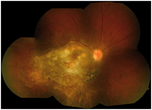 Figure 6. Fundus photograph (case 2) at 1 month follow-up showing healing lesions after anti-toxoplasma therapy was initiated.