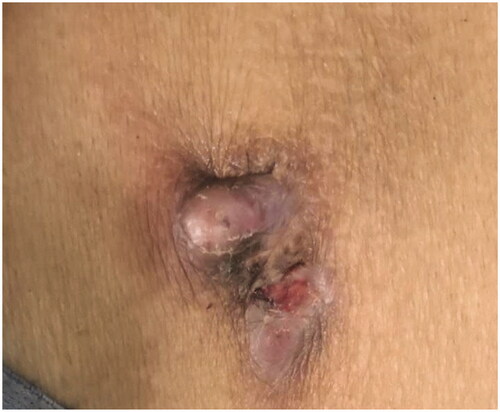 Figure 4. The infection of exit site of peritoneal dialysis catheter of case 3.