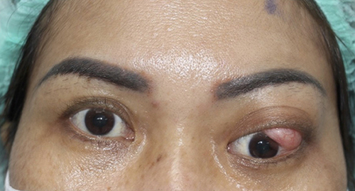 Figure 5 The picture shows the mass progressive growth and prolapse into the palpebral fissure.