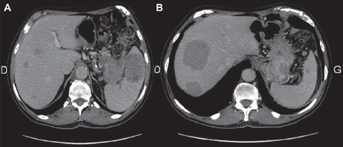Figure 1. March 2009 (A) CT-scan revealing the pancreatic tumor with spleen invasion (B) liver metastasis. CT, computed tomography.