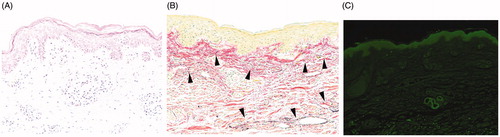 Figure 2. (A) Palpebral skin exhibits epidermal spongiosis and perivascular lymphocyte infiltration, suggesting superficial dermatitis compatible with blepharochalasis (hematoxylin and eosin, ×200). (B) Elastic fibers are reduced in the superficial dermis and exhibit fragmentation (arrowhead, elastica van Gieson, ×200). (C) Immunostaining reveals perivascular IgA deposits (arrow, ×100).