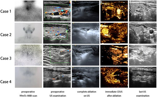 Figure 2. Representative imaging scans of cases 1–4 before and after thermal ablation.