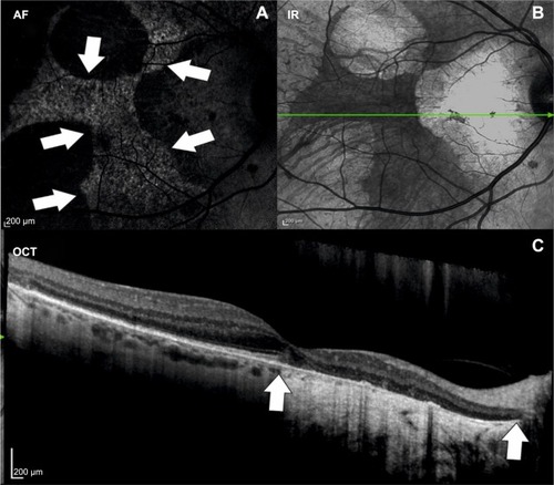 Figure 2 Multimodal imaging of a patient with choroideremia.