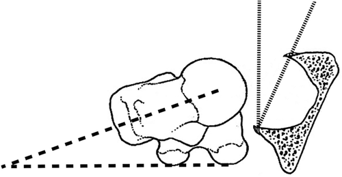 Diagram with transverse section of acetabulum and axial view of femur.