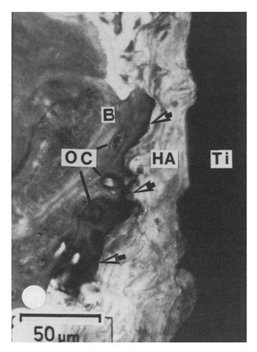 Figure 5. Light micrograph of the HA coated titanium to bone interface. Arrows indicate the dark interfacial region of organic, non-collagenous material. Reproduced with permission from reference Citation45.