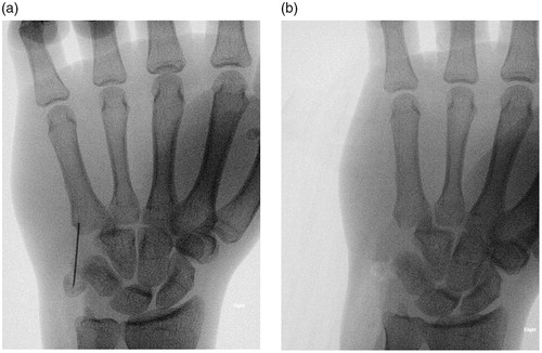 Figure 4. (a) X-ray (anteroposterior view) of the right hand before complete excision and removal of the comminuted pisiform. (b) X-ray (lateral view) of the right hand after complete excision and removal of the comminuted pisiform.