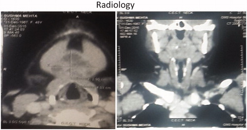 Figure 2. CT scan of Neck axial cuts showing well encapsulated cystic lesion with areas of heterogeneity within the cyst.