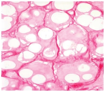 Figure 5 Histologic photomicrograph of calcium hydroxlyapatite with neocollagenesis at 16 months in a canine model.