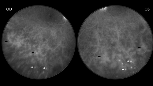 Figure 3. Fluorescein angiogram of both eyes of the same sarcoidosis patient with bilateral panuveitis. The black arrows indicate vascular leakage, the white arrows indicate hyperfluorescent dots corresponding to multiple atrophic chorioretinal lesions.