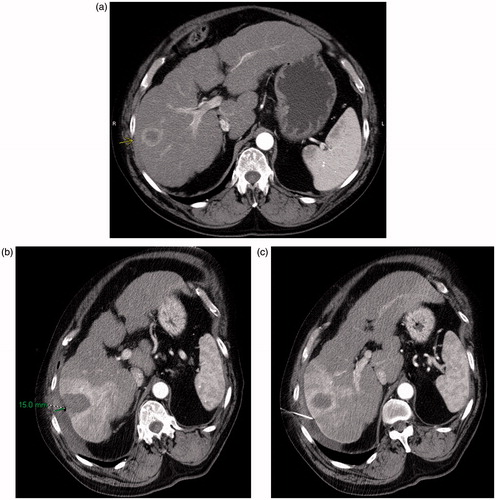 Figure 2. (a) Preablation contrast enhanced CT demonstrates an arterially enhancing right lobe HCC. The overlying liver capsule directly abuts the body wall, putting this patient at risk for postprocedural pain. (b) Postablation contrast enhanced CT demonstrates postablation changes as well as instillation of artificial ascites, measuring 15 mm in thickness between the body wall and the liver capsule. (c) Postablation contrast enhanced CT demonstrates the artificial ascites needle still in place, allowing for continuous instillation of fluid during the ablation procedure.
