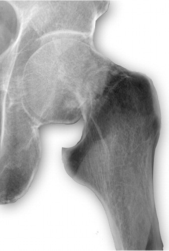 Figure 4. a. Displaced femoral neck fracture.