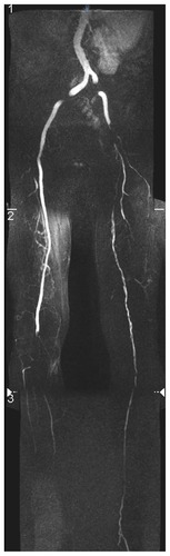 Figure 2 Magnetic resonance angiography showing occlusion of the right superficial femoral artery above the knee and long high-grade stenosis of the left superficial and profound femoral arteries and of the arteries of the left lower leg (arrows).