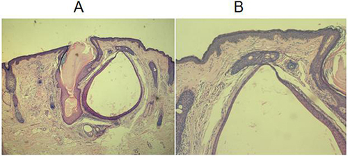 Figure 2 (A) Epidermis became thinner, and the pilosebaceous orifice expanded in a cystic manner, containing keratin plugs, extending to the deep layer of the dermis (HE×10). (B) Collagen fibers in the superficial layer of the dermis became basophilic with the formation of cysts (HE×20).