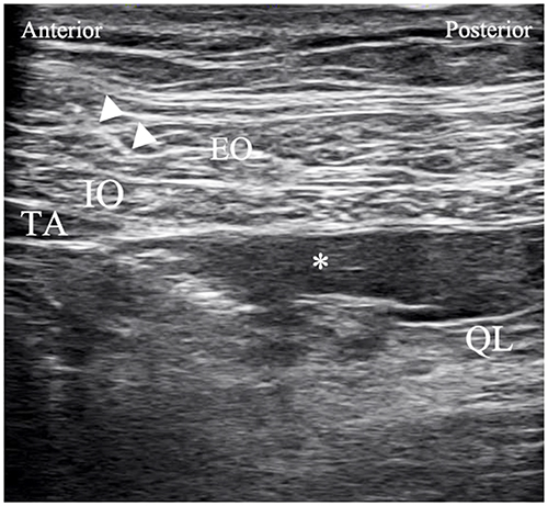 Figure 1 Postinjection ultrasound image of quadratus lumborum block. Triangles indicate needle path. Asterisk represents the spread of local anesthetics.