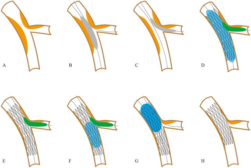 Figure 1. Schematic image depicting the key steps of the hybrid technique. (A) Coronry bifurcation lesion. (B) Preparation for main branch. (C) Preparation for side branch. (D) Stent deployment kissing inflation with drug coated balloon (DCB). (E) Persistent inflation of DCB when removing stent balloon. (F) Balloon post-dilation of bifurcation core kissing with DCB. (G) Proximal optimization technique. (H) Final results.