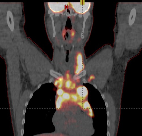 Figure 1 Case: pre-chemotherapy PET/CT for 20 years old patient with Stage IIA cHL. Patients received ABVD x 4 cycles, achieving a complete metabolic response after 2 cycles (Deauville 3), confirmed after 4 cycles (Deauville 2). Consolidation radiotherapy was planned with a total dose of 30Gy in 15 fractions.