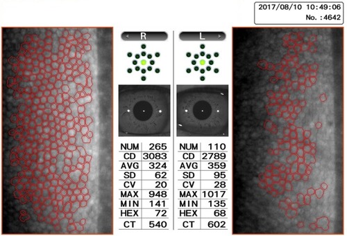 Figure 2 Specular microscopy showing CECD of both eyes at the initial visit.