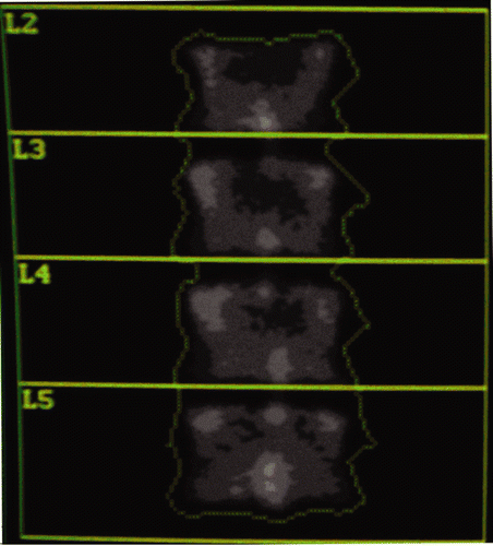 Figure 1.  Bone mineral image with standard region of interest including L2–L5, is done at the start and end of the experiment as an independent check of system calibration.
