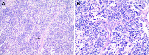 Figure 2 Histopathological sections of the mass.