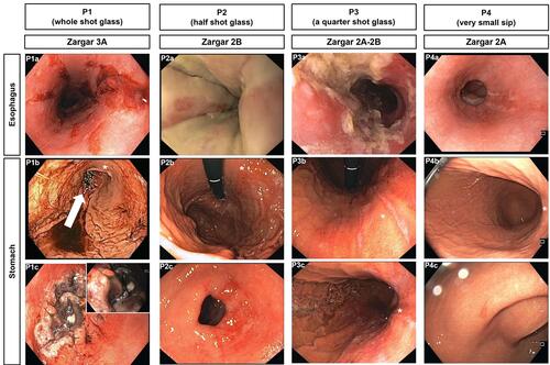 Figure 1 Images from early performed gastroscopy for patients P1-P4. Esophageal lesions are documented in the first row, the following rows show lesions in the stomach. The white arrow (P1b) marks a focal necrosis (approximately 3 cm) in the antrum, which is shown in more detail in P1c (Zargar 3A). The other patients had ulcerations without necrosis (Zargar 2). The asterisk (*) marks the small curvature.
