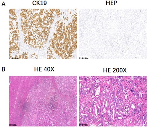 Figure 2 Pathological detection of surgical biopsy. Immunohistochemical staining of CK19 and HEP was performed on the surgical biopsy (A). In addition, the typical morphology of differentiated cholangiocarcinoma was evaluated by HE staining (B).