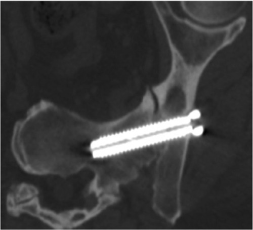 Figure 3 Six-month postoperative orthogonal view demonstrating bridging bone with no evidence of lucency.