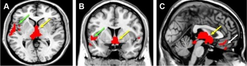 Figure 1 Voxel-based morphometric analysis of polysubstance users (n=46) and healthy control patients (n=30).