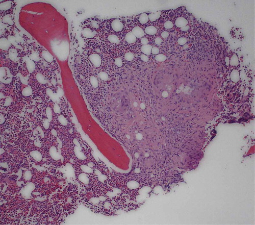 Figure 2. Bone marrow biopsy of the lumbar spine showing non-caseating granuloma suggestive of sarcoidosis
