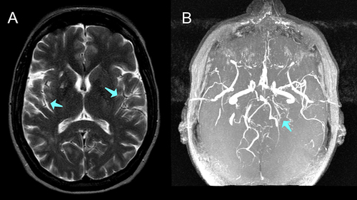 Figure 1 A 35-year-old female presented with headaches. Imaging work was done which included T2 MRI (A) and MRA (B) which showed bilateral internal carotid artery tapering (blue arrows) with near-complete occlusion at the carotid termini and presence of skull base collateral vessels, diagnostic of Moyamoya syndrome. On the right, the supraclinoid internal carotid artery shows loss of signal below the posterior communicating artery, with collateral vessels at the skull base. The left displays decreased caliber at the supraclinoid portion with no signal at the carotid terminus. Both sides show collateral vessels at the skull base, indicating a compensatory response to the occlusions.