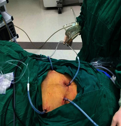 Figure 1 Placement of four tubes via the laparoscopic ports.