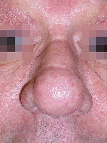 Figure 2. Crusts and partial improvement could be seen 1 week after laser treatment.