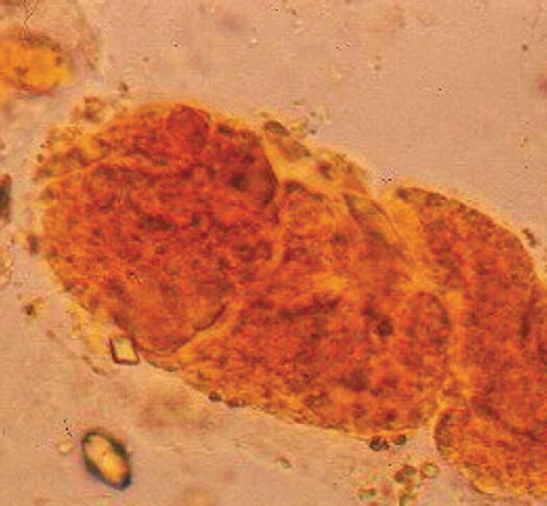 Figure 1. Bilirubin-stained epithelial cells (bilirubin casts) was apparent upon microscopy of centrifuged urine sample