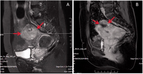 Figure 1. MR images obtained from a 44-year-old patient. She had no symptoms, but came for HIFU treatment. (A) T2WI showed two lesions, one hyperintense mass with an ill-defined margin located at the fundus of the uterus (arrows) which was suspected to be a uterine sarcoma; another one located adjacent to the cervix of the uterus with hypointense, well defined margin which was a uterine fibroid. (B) Contrast-enhanced MRI showed irregular enhancement of the lesion located at the fundus of the uterus (arrows). After reviewing the pre-HIFU MRI, the patient was referred to surgery. She was histologically diagnosed as LMS.