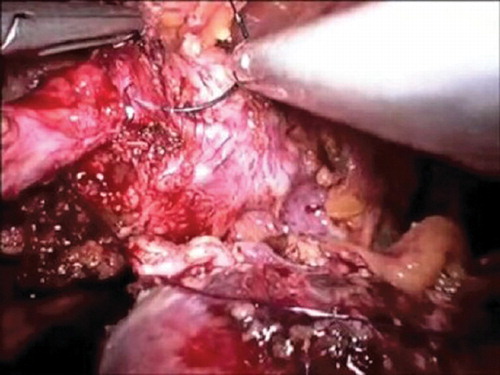 Figure 3. Intravenous pyelogram three months after surgery.