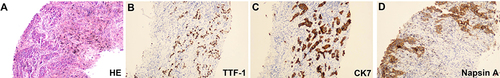 Figure 1 Histological findings. (A) Hematoxylin and eosin (HE) staining. (B–D) IHC results of TTF-1, CK7 and Napsin A.