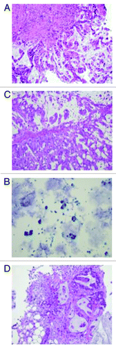 Figure 2. (A) Original liver fine needle aspiration biopsy performed in May 2010, slide with papanicolau staining (×200). Cancer cells are stained in blue with high nuclear cytoplasmic ratio. (B) Colon mucosa from first cytoreductive therapy, original H&E staining (×200): adenocarcinoma with mucinous feature is observed. (C) As shown in Figure 4C, LUQ mass grew despite stable other metastatic lesions. Biopsy was performed to confirm the malignancy of the mass. H&E staining (×200) confirmed colonic origin mucinous adenocarcinoma. (D) Biopsy of small bowel anastomosis site was re-biopsied to confirm the disease progression. H&E staining (×200) showed mucinous adenocarcinoma with similar morphology with original biopsy.